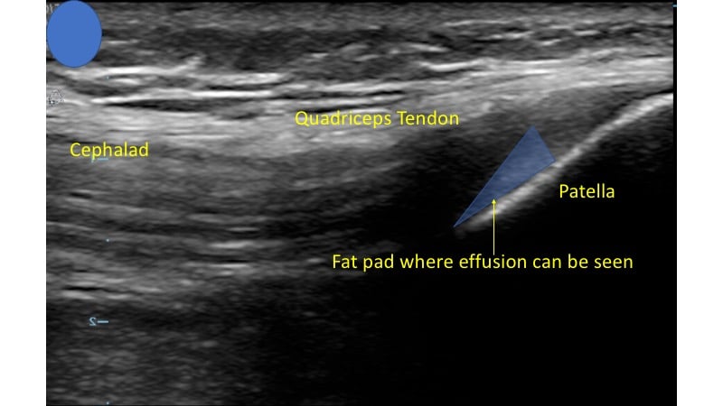 Figure 4 - US demonstrating normal knee.jpg