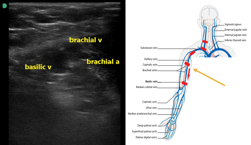 Figure 7 brachial and basilic veins.png
