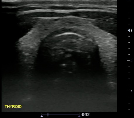 -Figure 31- Thyroid.jpg